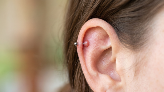 Top 5 Natural Remedies to Get Rid of a Piercing Bump